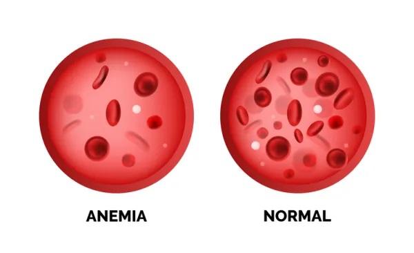 Me cuesta respirar hondo y bostezo mucho: ¿por qué y qué hago? - Anemia