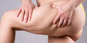 ¿Problemas circulatorios en las piernas? Podrían ser síntomas de lipedema