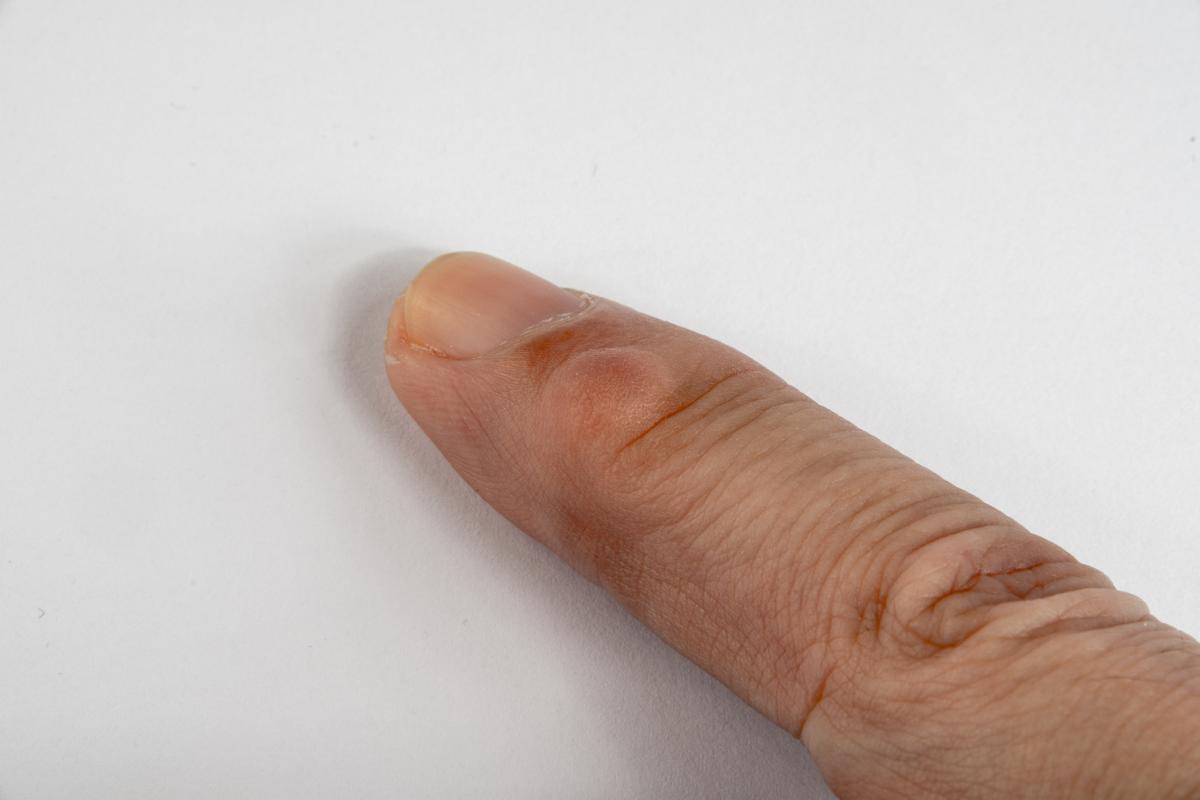 Bulto en el dedo de la mano: causas y tratamiento