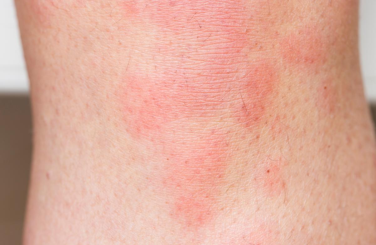 Urticaria por calor: síntomas, tratamiento y remedios caseros