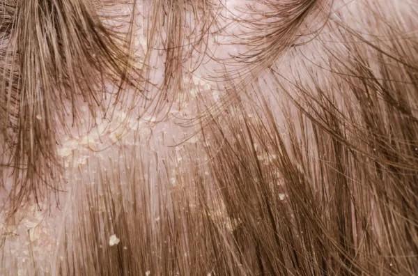 ¿Por qué me pica la cabeza por la noche y cómo aliviarlo? - Caspa o dermatitis seborreica