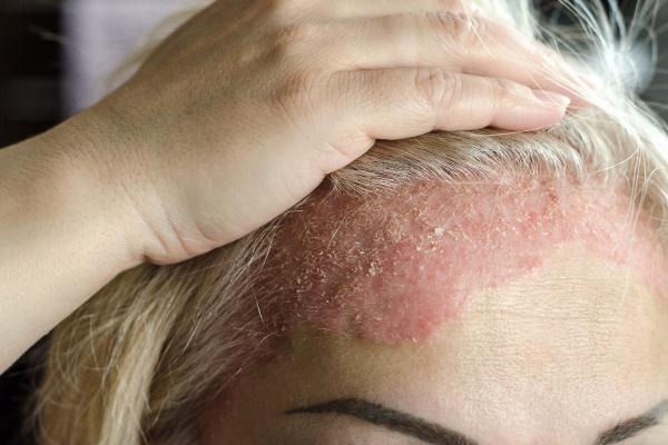 ¿Por qué me pica la cabeza por la noche y cómo aliviarlo? - Psoriasis