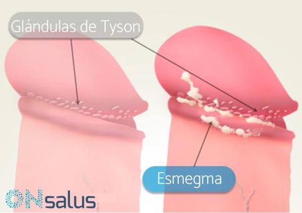 Qué es el esmegma y cómo quitarlo