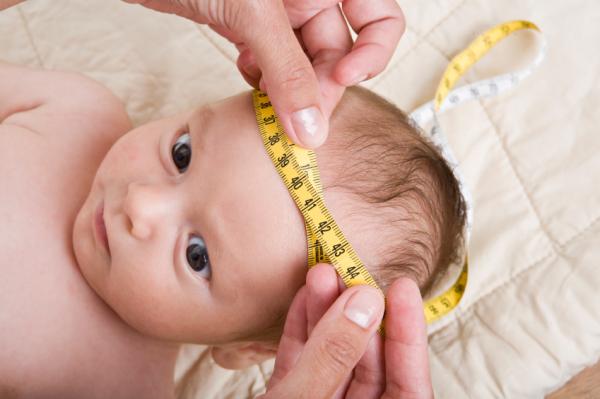 Microcefalia: qué es y cuáles son sus complicaciones