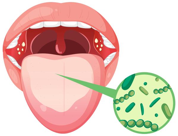 Síntomas de Helicobacter pylori en la boca y la lengua - Síntomas de Helicobacter pylori en la boca y lengua más comunes