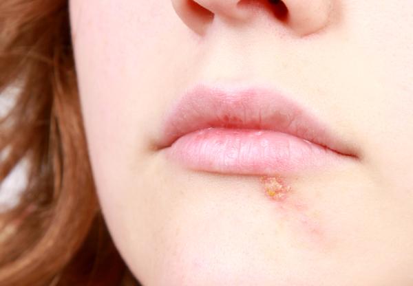 ¿El herpes labial es contagioso? Aquí la respuesta - Qué es el herpes labial