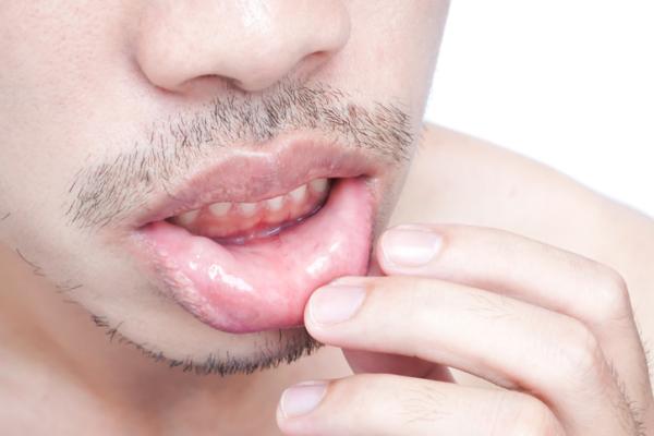 Hormigueo en los labios: causas y tratamiento