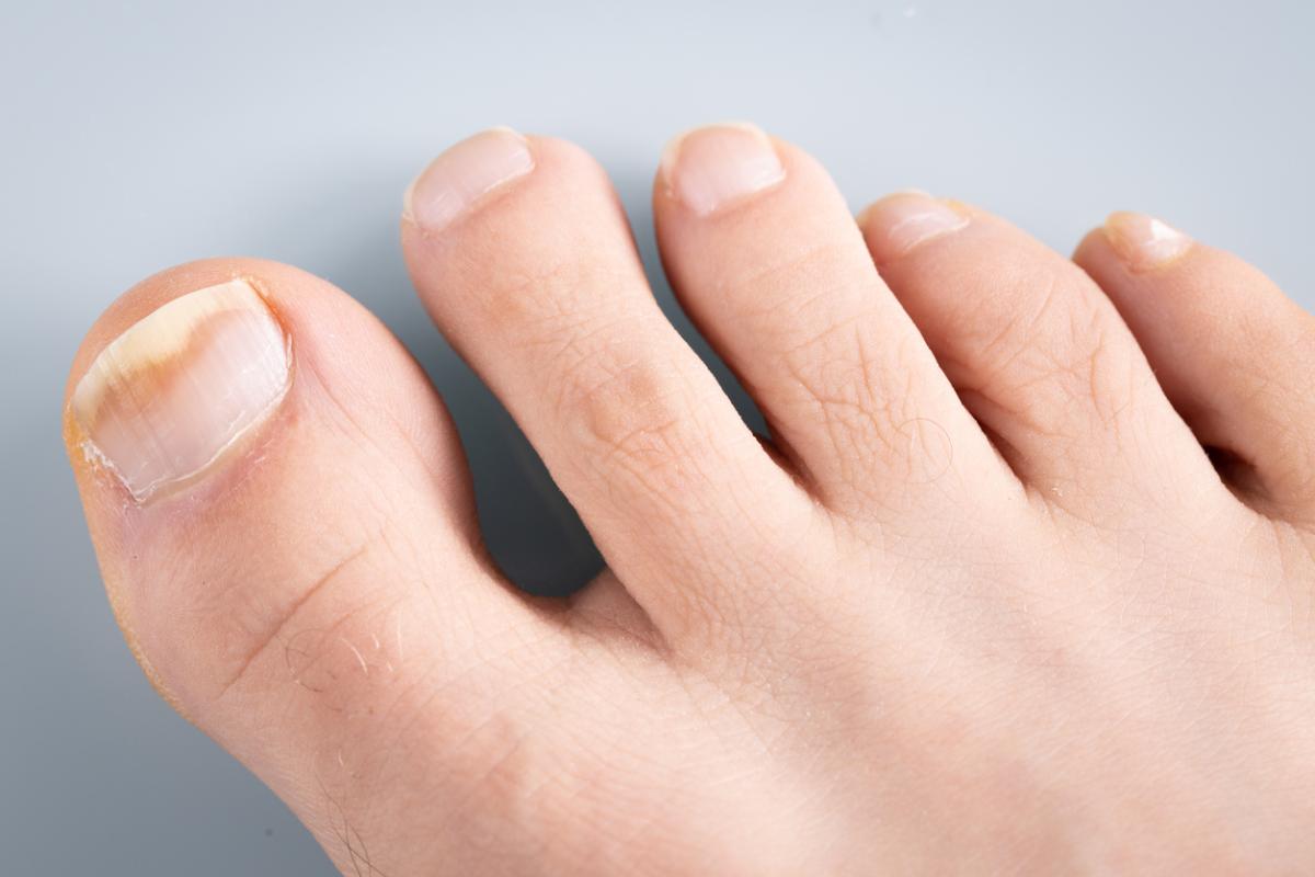 Cómo curar las uñas huecas de los pies