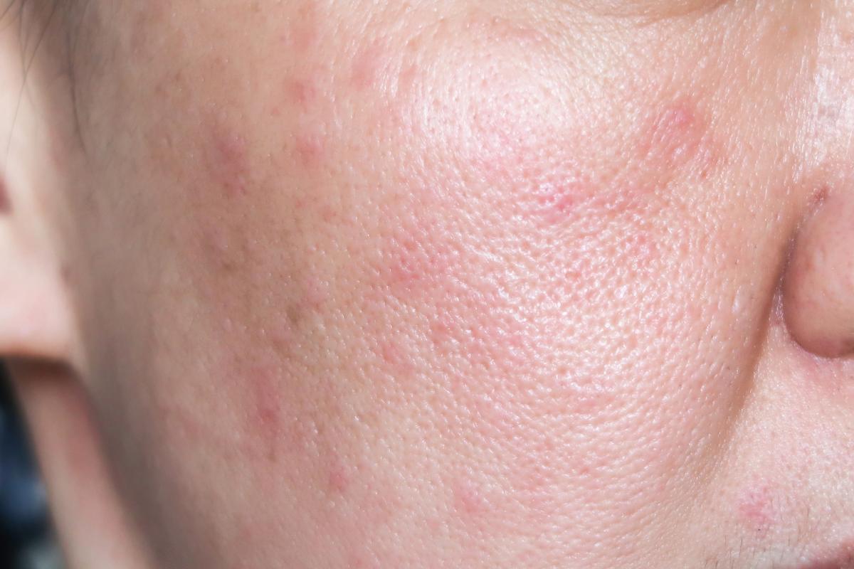 Sarpullido en la cara sin picor: causas y tratamiento