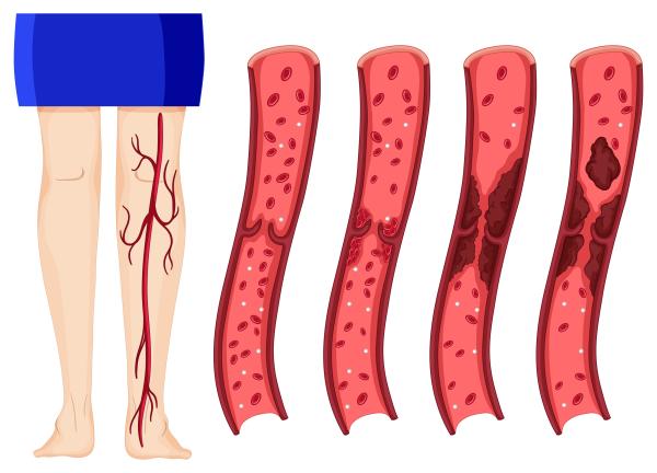 Dolor de piernas al levantarse después de estar sentado: causas y tratamiento - 1. Problemas circulatorios