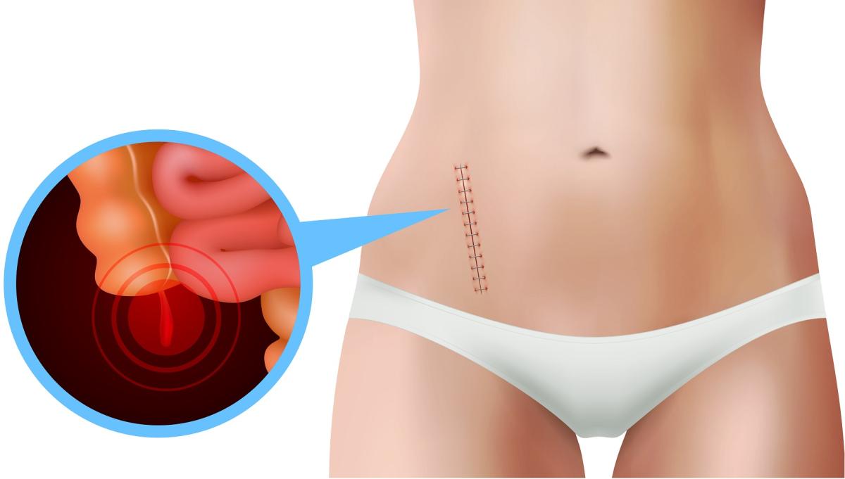 ¿Es normal tener pinchazos después de una operación de apendicitis?