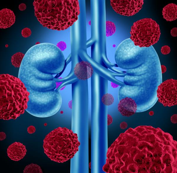 Sangre en la orina: causas - Cáncer renal o en la vejiga
