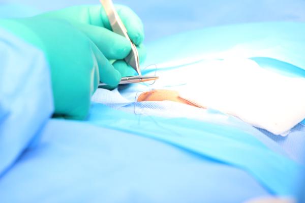 Hernia de hiato: causas, síntomas y tratamiento - Tratamiento
