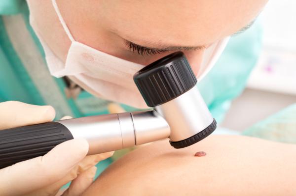 10 síntomas del cáncer que deberías conocer - Alteraciones en la piel