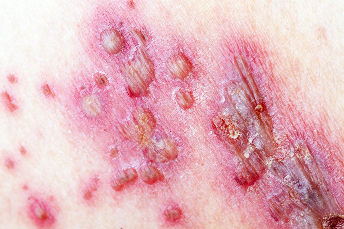Herpes en el ano: síntomas, causas y tratamiento