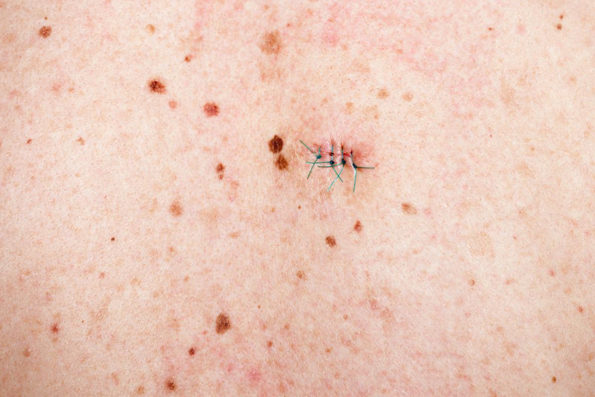 Cómo curar una herida infectada con puntos