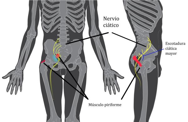 Dolor en el coxis sin golpe: causas y tratamiento - Inflamación del nervio ciático