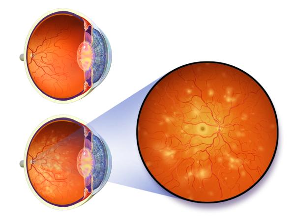 Retinopatía diabética: síntomas, clasificación, causas y tratamiento