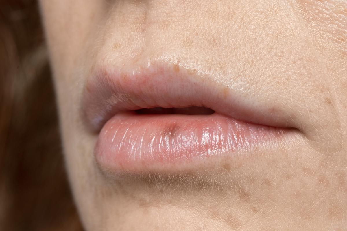 Bulto en el labio inferior: causas y tratamiento