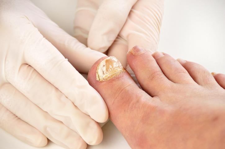 Uñas Gruesas en los Pies: Tratamiento y Remedios Efectivos