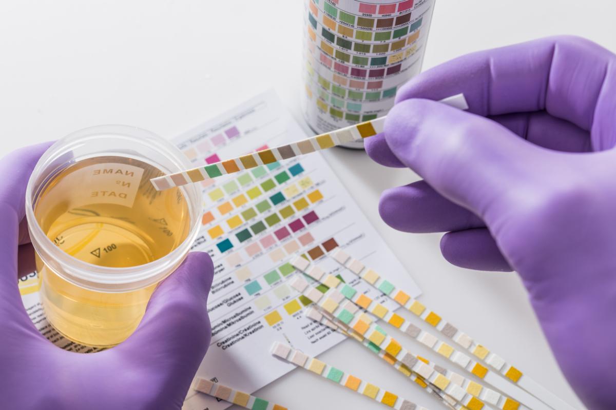 Qué significa la orina con olor dulce