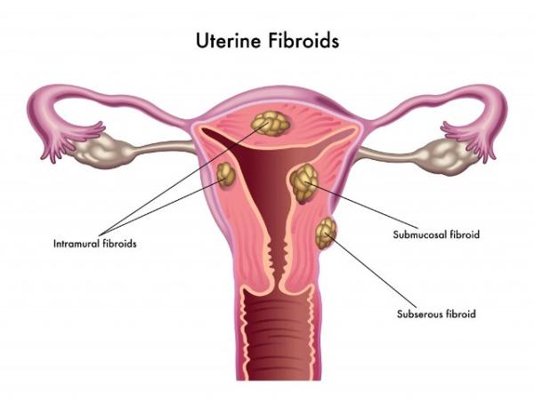 Mioma uterino: síntomas, causas y tratamiento