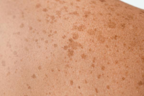 Manchas marrones o cafés en la espalda: causas y tratamiento - Lentigos solares