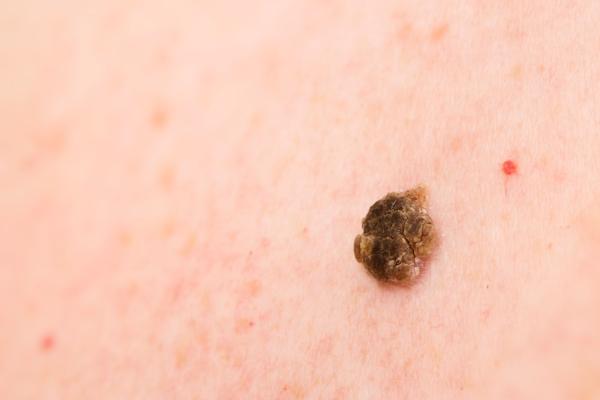 Manchas marrones o cafés en la espalda: causas y tratamiento - Queratosis seborreica