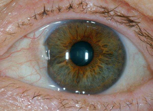 Carnosidad en los ojos: causas, síntomas, operación y remedios caseros - Carnosidad en el ojo: síntomas