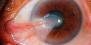 Carnosidad en los ojos: causas, síntomas, operación y remedios caseros
