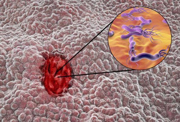 Dolor abdominal al presionar y soltar: causas y tratamiento - Úlcera estomacal