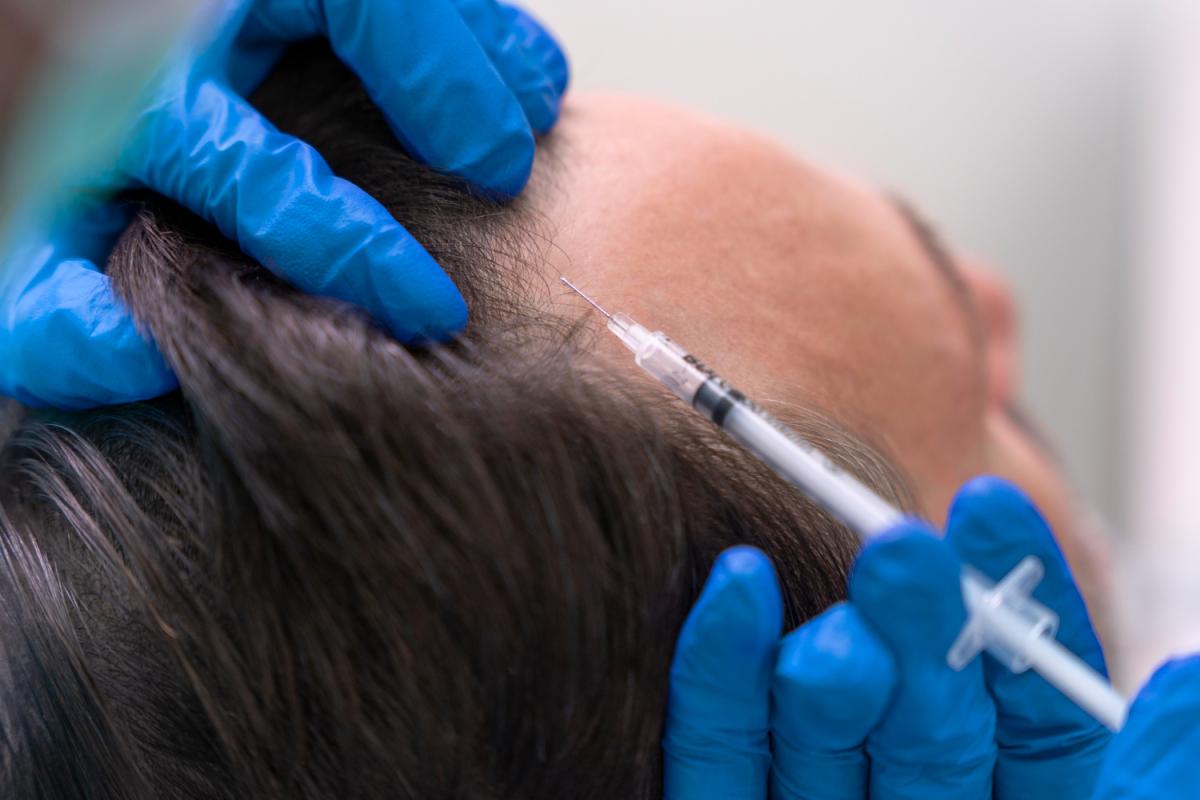 De la mesoterapia al injerto: los tratamientos más demandados en una clínica capilar en Madrid