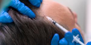 De la mesoterapia al injerto: los tratamientos más demandados en una clínica capilar en Madrid