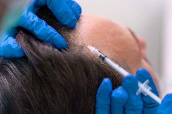 De la mesoterapia al injerto: los tratamientos más demandados en una clínica capilar en Madrid